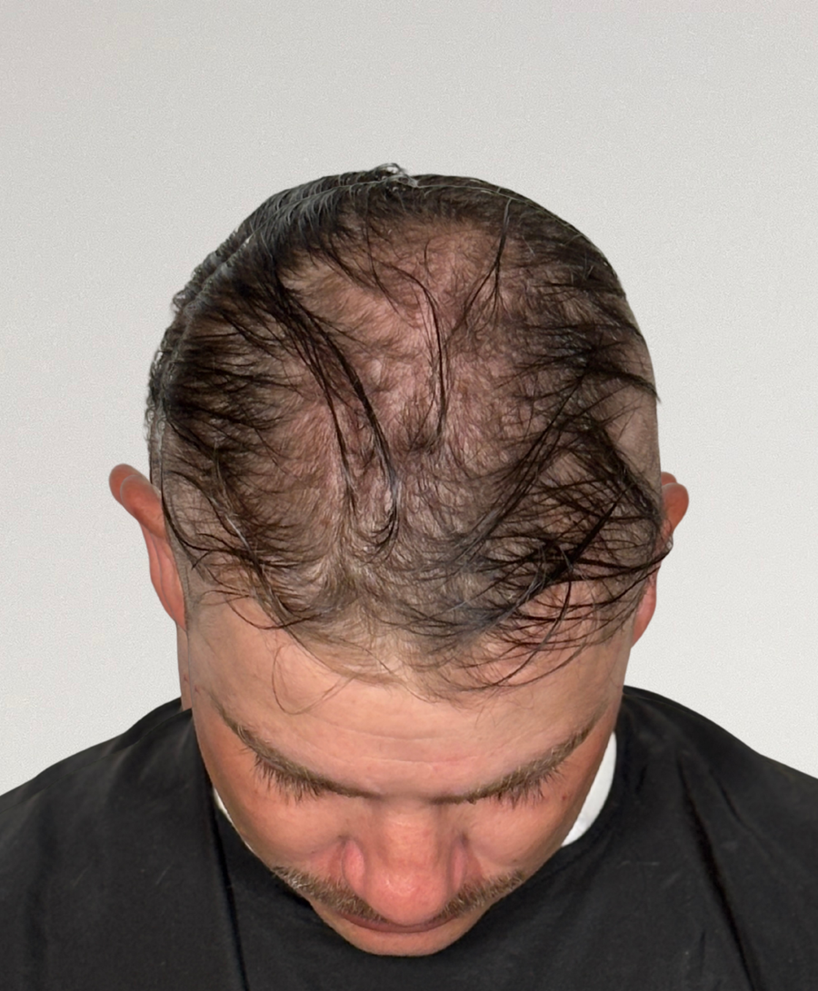 Hair restoration patient before treatment, thinning