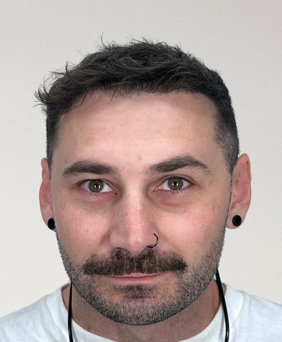 The same patient 6 months, treated by Dr Diana Phan