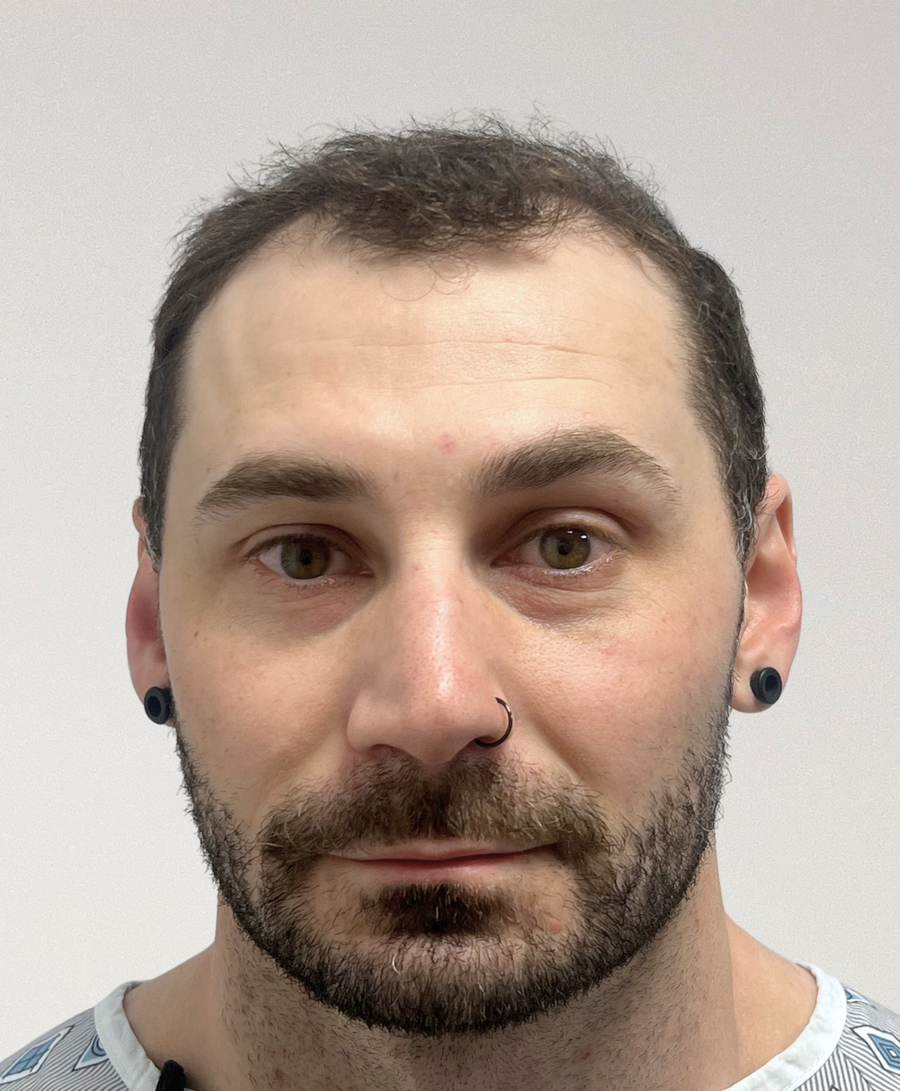 Hair restoration patient before treatment, age 35, receding hairline