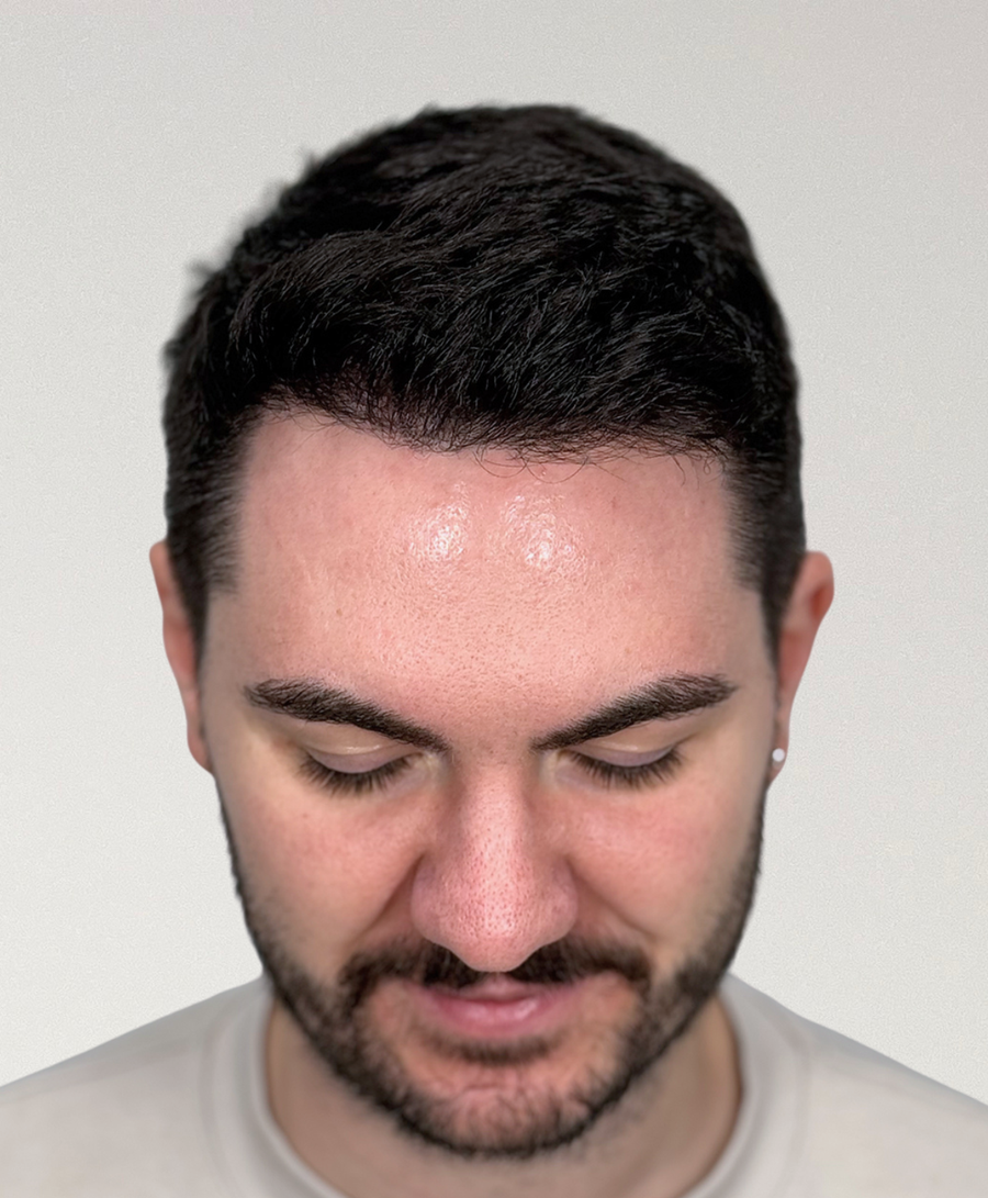 The same patient 6 months , treated by Dr Diana Phan
