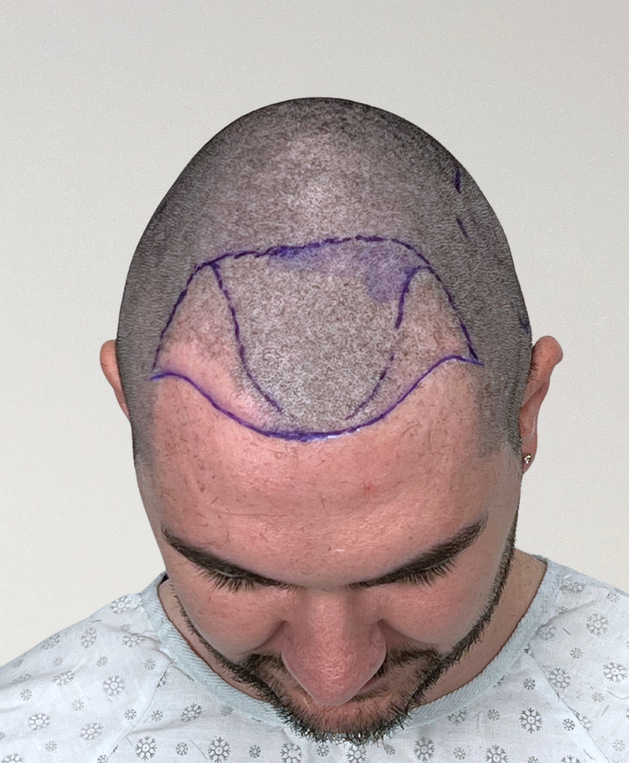 Hair restoration patient before treatment, age 32, receding hairline