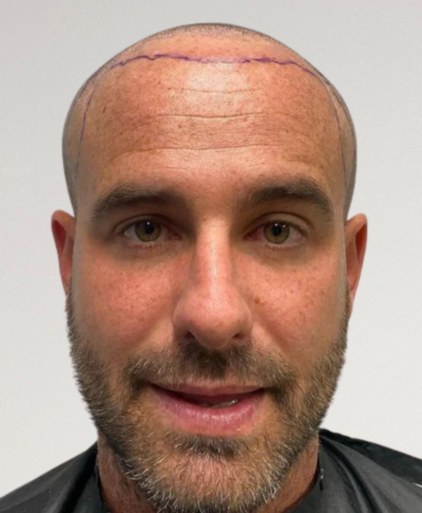before hair restoration