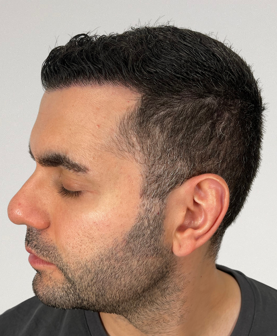 The same patient 6 months, treated by Dr Diana Phan