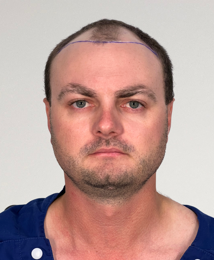 Hair restoration patient before treatment, age 33, receding hairline, balding