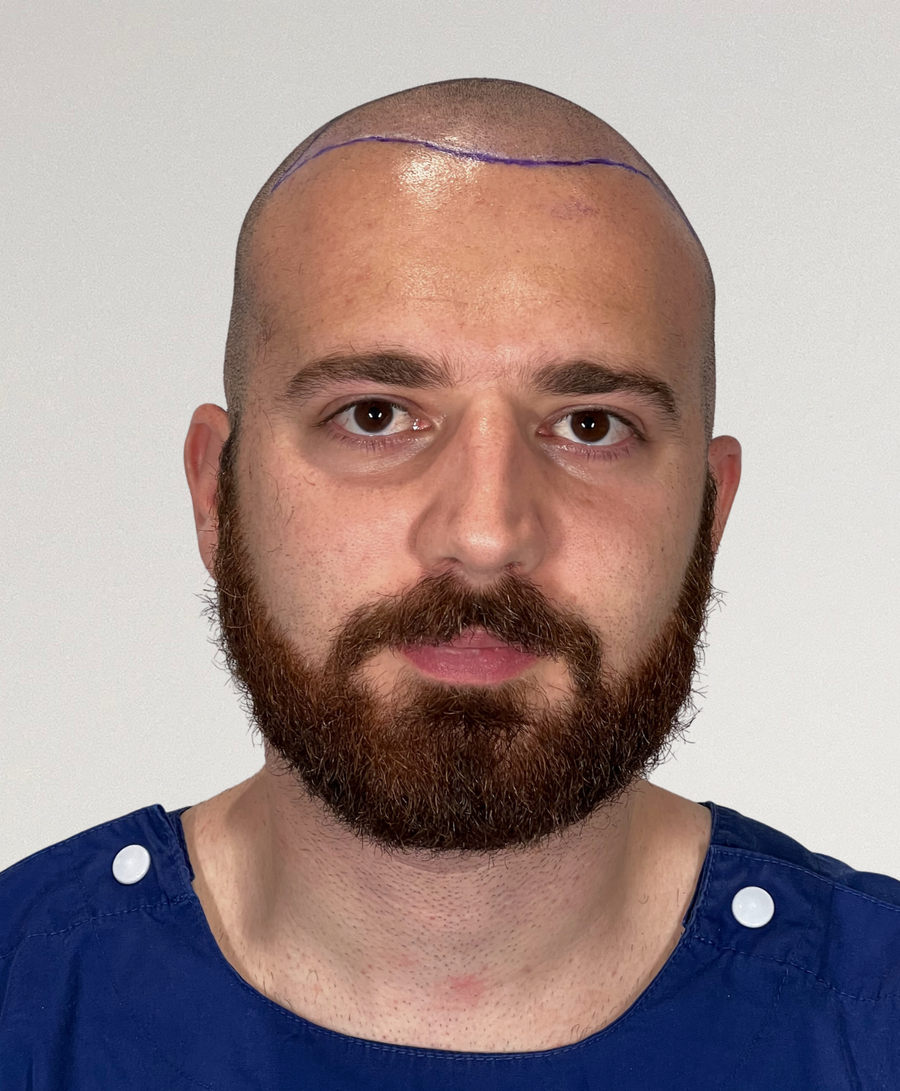 Hair restoration patient before treatment, age 29, thinning, balding