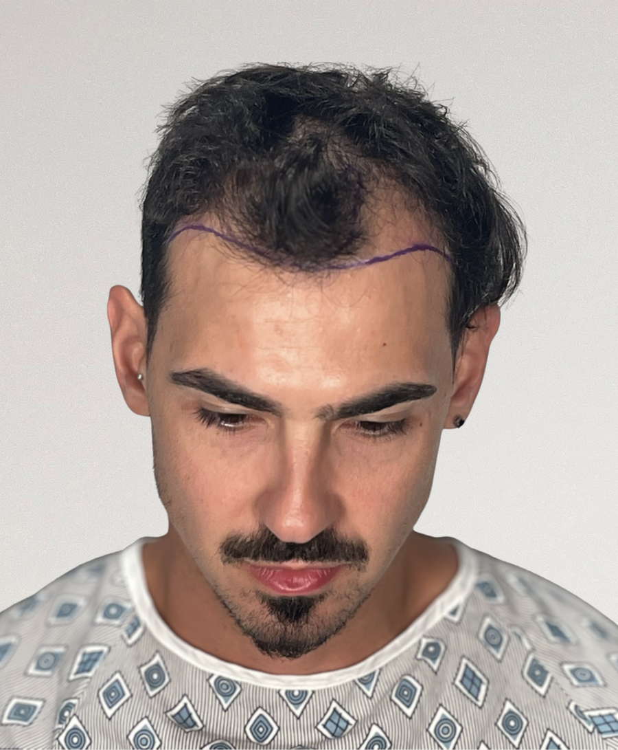 Hair restoration patient before treatment, age 31, receding hairline, thinning