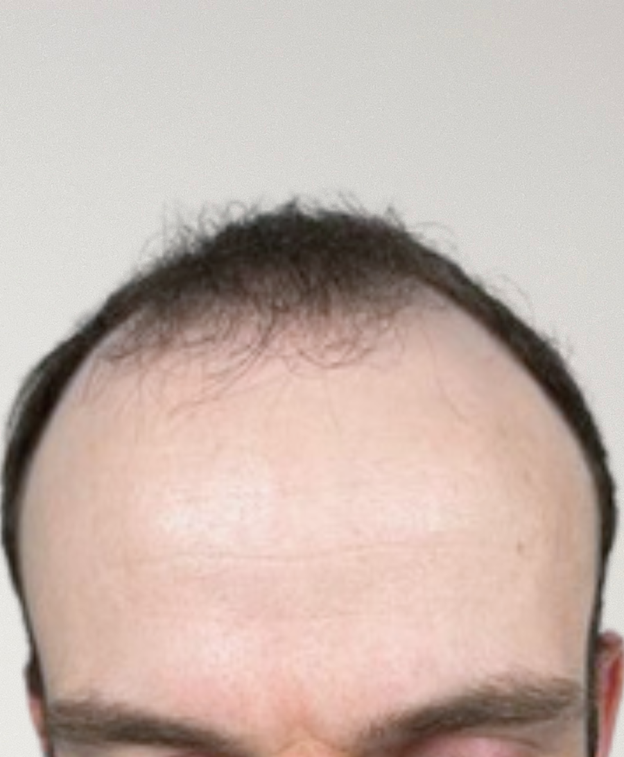 Hair restoration patient before treatment, age 36, receding hairline