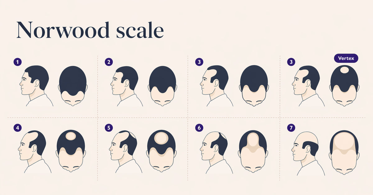 Norwood Scale by Gro Clinics