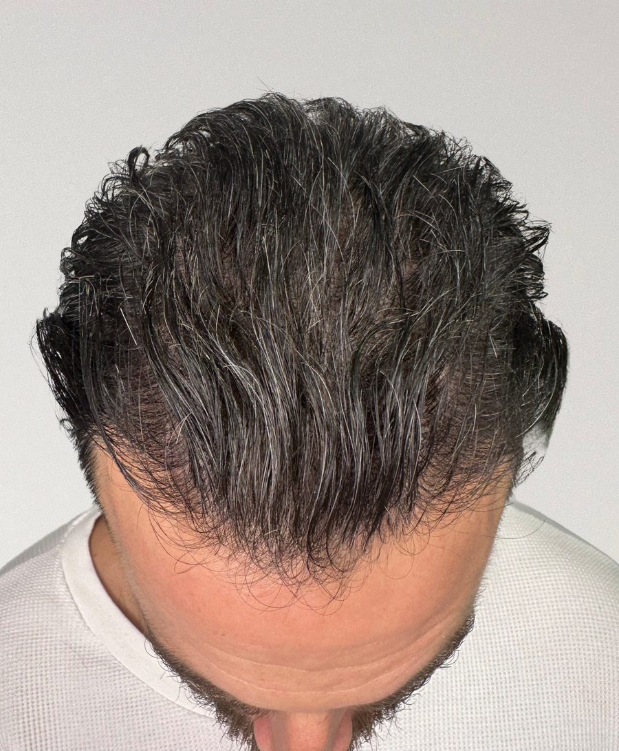 The same patient 12 months, treated by Dr Muchi Mandishona