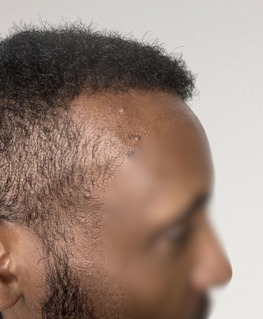 The same patient 6 months, treated by Dr Muchi Mandishona
