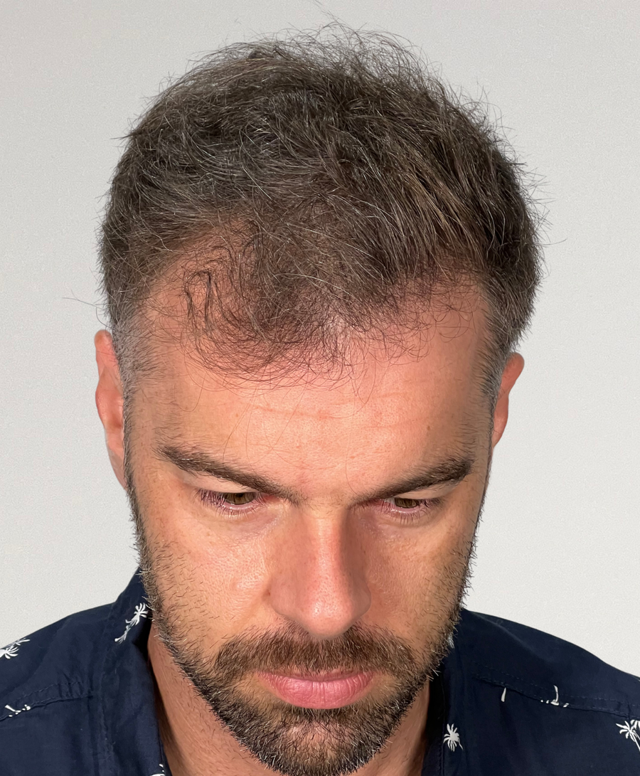 Hair restoration patient before treatment, age 40, receding hairline, thinning
