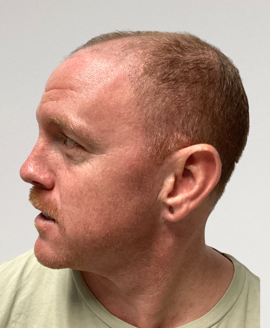 Hair restoration patient before treatment, age 37, receding hairline, thinning