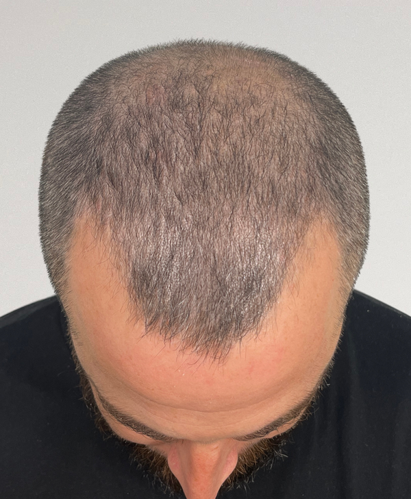 Age 36, before hair restoration