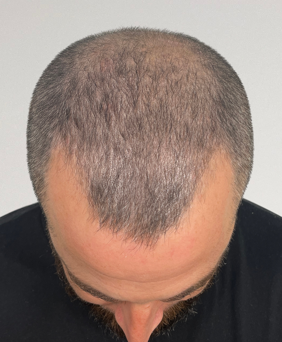 Hair restoration patient before treatment, age 36, receding hairline, thinning
