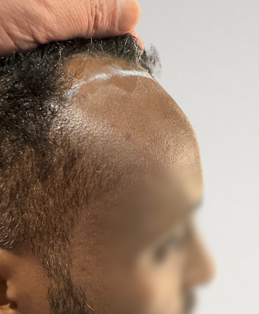 Hair restoration patient before treatment, age 36, receding hairline