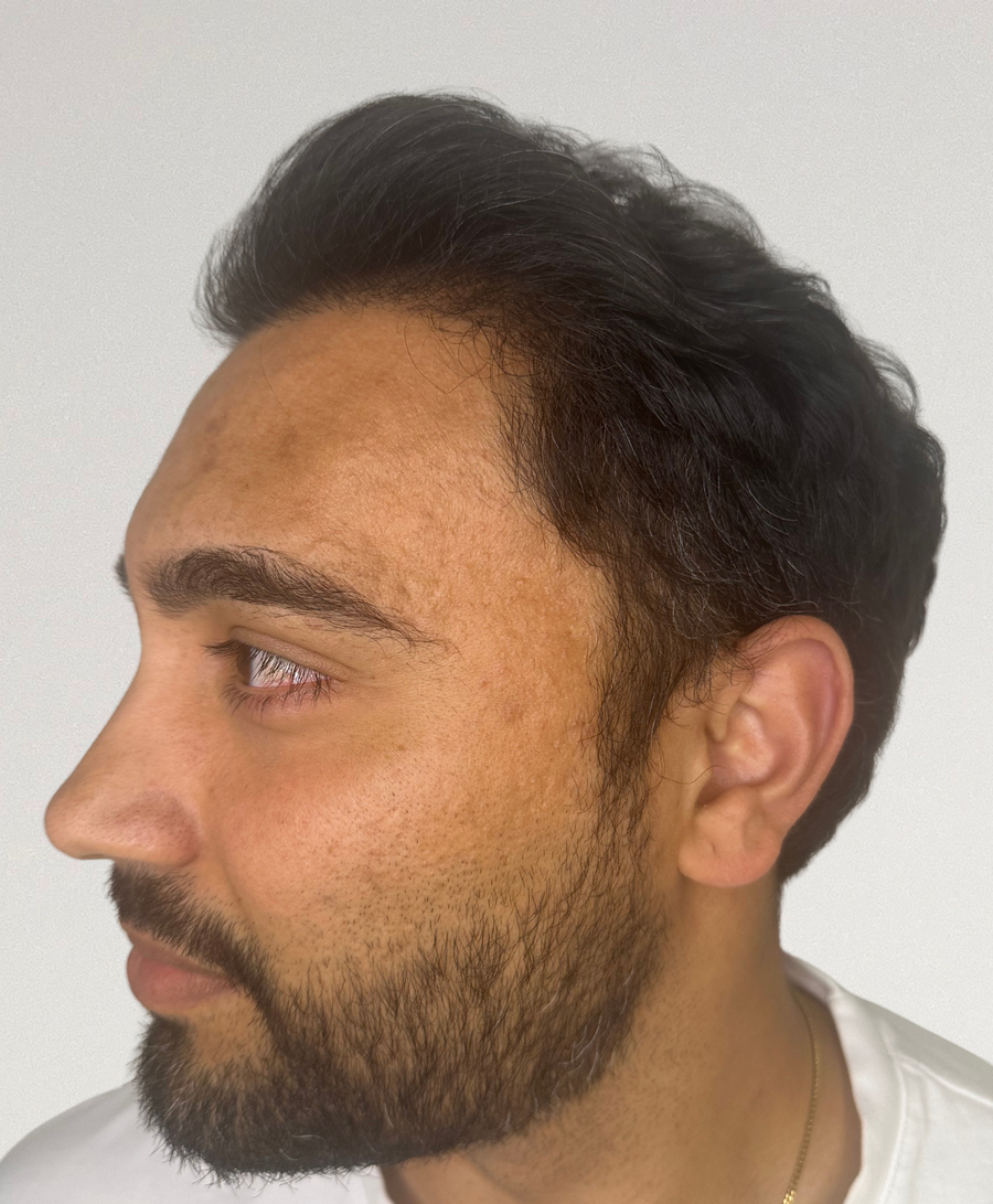 The same patient 6 months, treated by Dr Muchi Mandishona