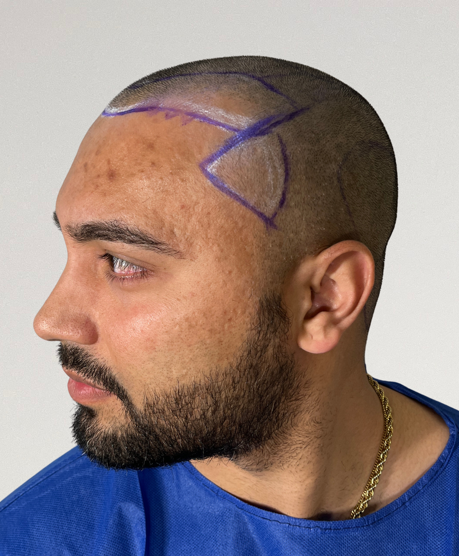 Hair restoration patient before treatment, age 32, receding hairline