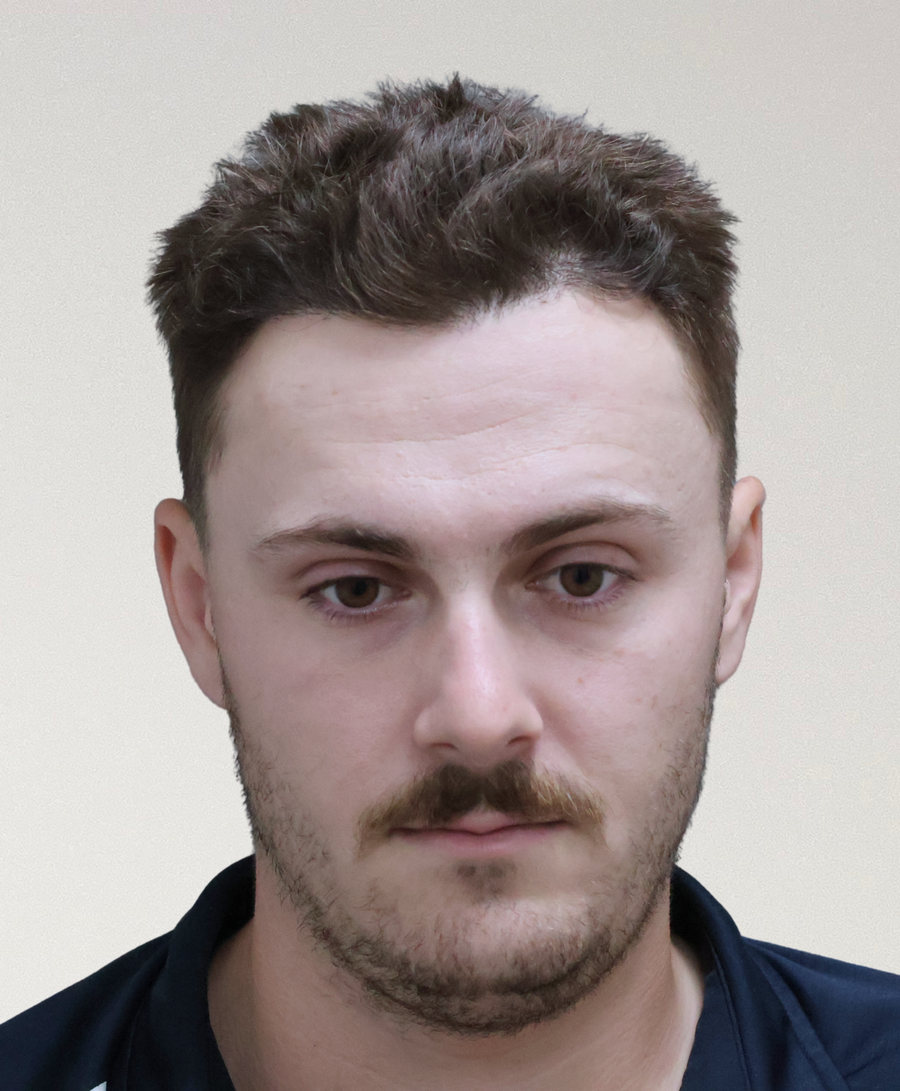 The same patient 6 months, treated by Dr David Ballantyne