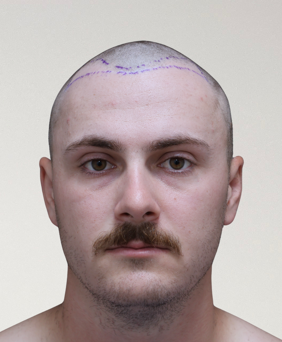 Hair restoration patient before treatment, age 25, receding hairline