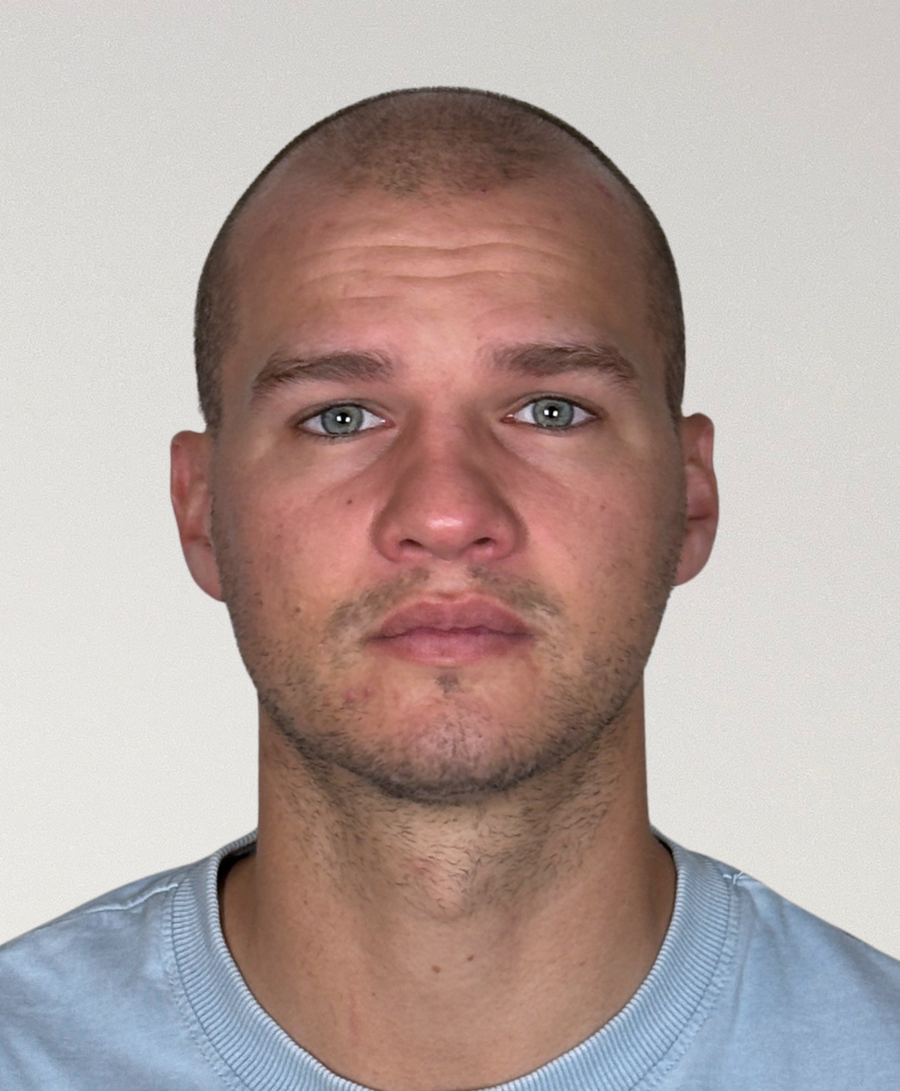 Hair restoration patient before treatment, age 28, receding hairline, balding