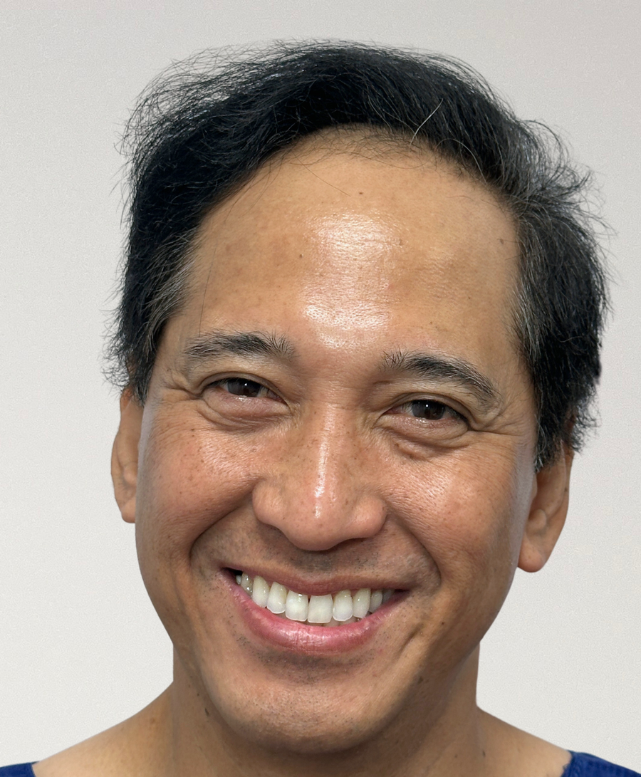Hair restoration patient before treatment, age 49, receding hairline