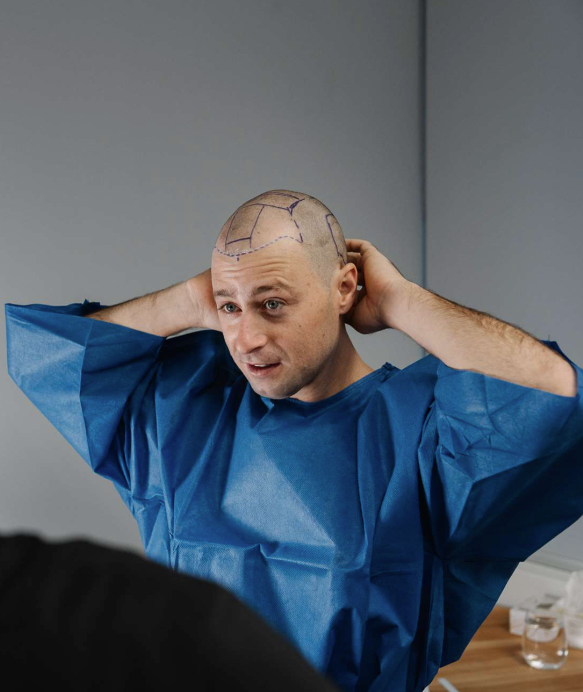 How a Natural Hairline Is Designed