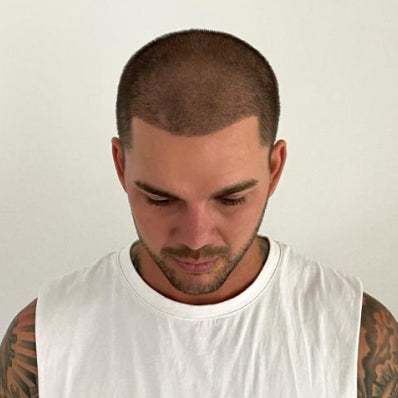 A non-surgical scalp treatment in progress at Gro Clinics